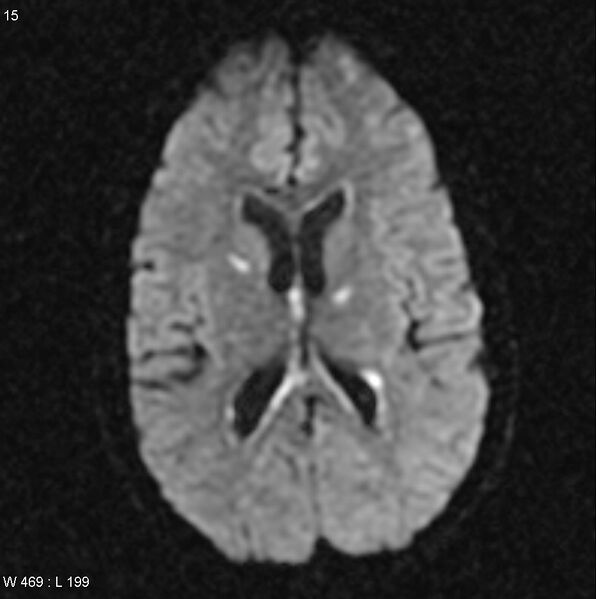 File:CMV ventriculitis and encephalitis (Radiopaedia 5416-7166 Axial DWI 4).jpg