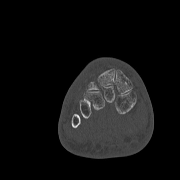 File:Calcaneal tuberosity avulsion fracture (Radiopaedia 22649-22668 Coronal bone window 33).jpg