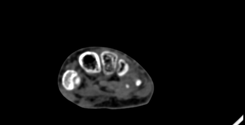Calcifying aponeurotic fibroma (Radiopaedia 88423-105064 B 124).jpg