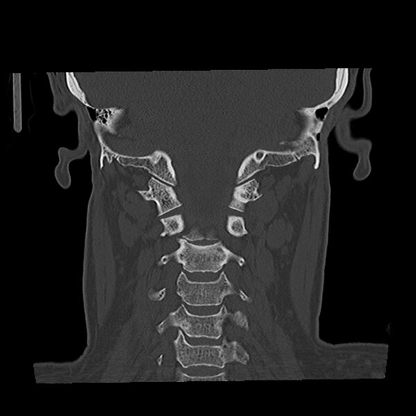 File:Canal up mastoidectomy (Radiopaedia 78108-90638 Coronal bone window 42).jpg