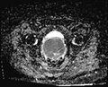 Cancer cervix - stage IIb (Radiopaedia 75411-86615 Axial ADC 13).jpg