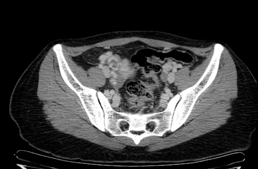 Cannonball metastases - uterine choriocarcinoma (Radiopaedia 70137-80174 A 11).jpg