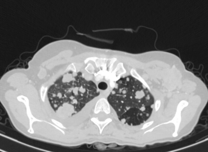 Cannonball metastases from breast cancer (Radiopaedia 91024-108569 Axial lung window 14).jpg