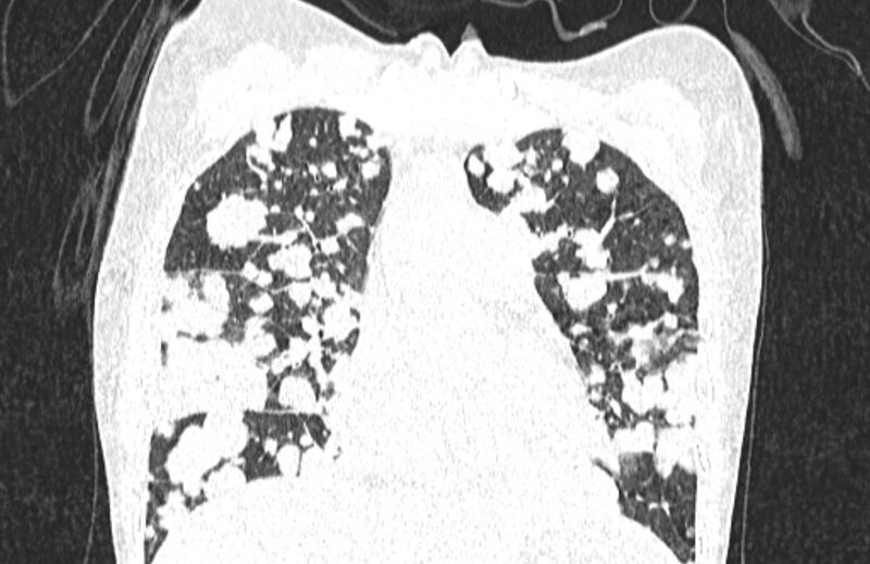 File:Cannonball metastases from breast cancer (Radiopaedia 91024-108569 Coronal lung window 54).jpg