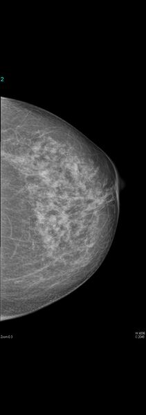 File:Carcinoma of left breast (Radiopaedia 28504-28746 CC 1).jpg