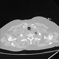 Cardiogenic pulmonary edema (Radiopaedia 29213-29609 Axial lung window 3).jpg