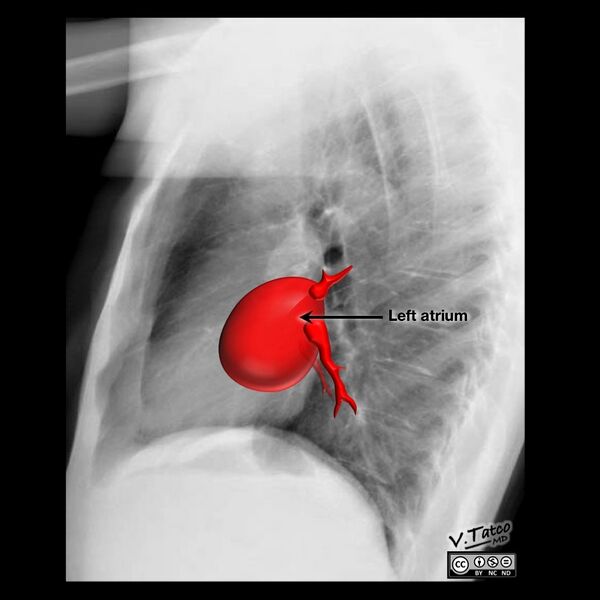File:Cardiomediastinal anatomy on chest radiography (annotated images) (Radiopaedia 46331-50772 Q 5).jpeg