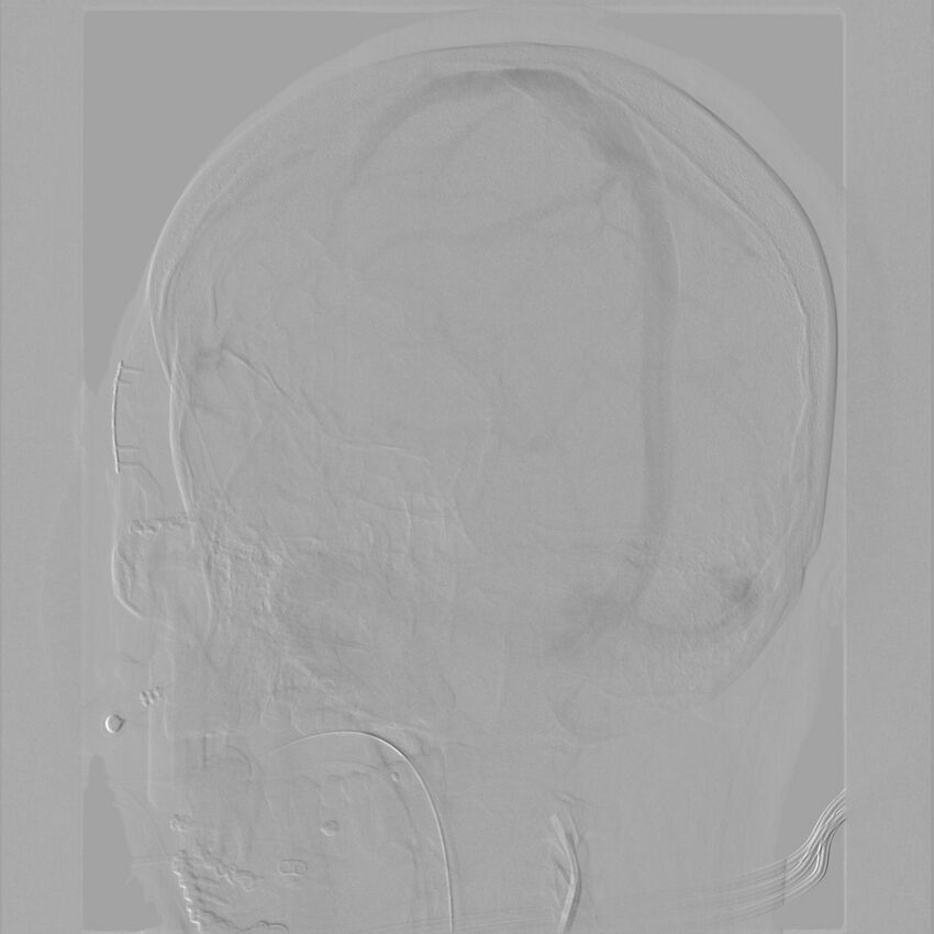 Caroticocavernous fistula - direct (Radiopaedia 61660-69666 Oblique Left ICA 63).jpg