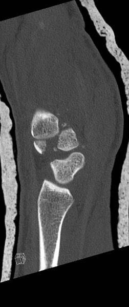 File:Carpal fractures (smart watch impaction) (Radiopaedia 55844-62430 Sagittal bone window 29).jpg