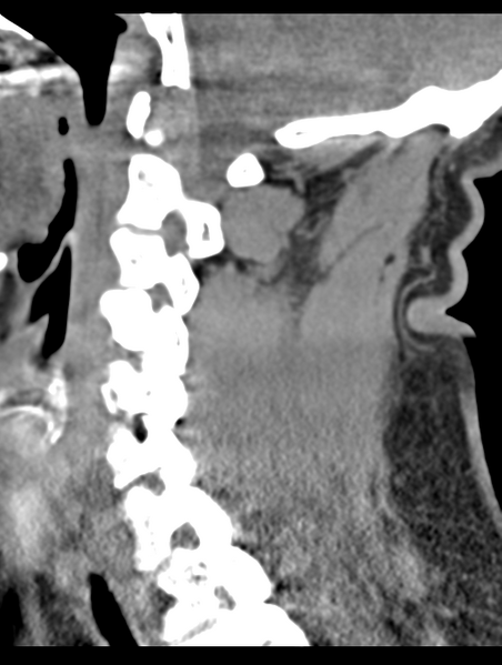 File:Cavernoma of cervical cord (Radiopaedia 50838-56346 B 34).png