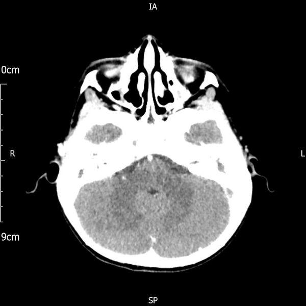 File:Cavernous sinus thrombosis (Radiopaedia 79414-92510 Axial Brain 67).jpg