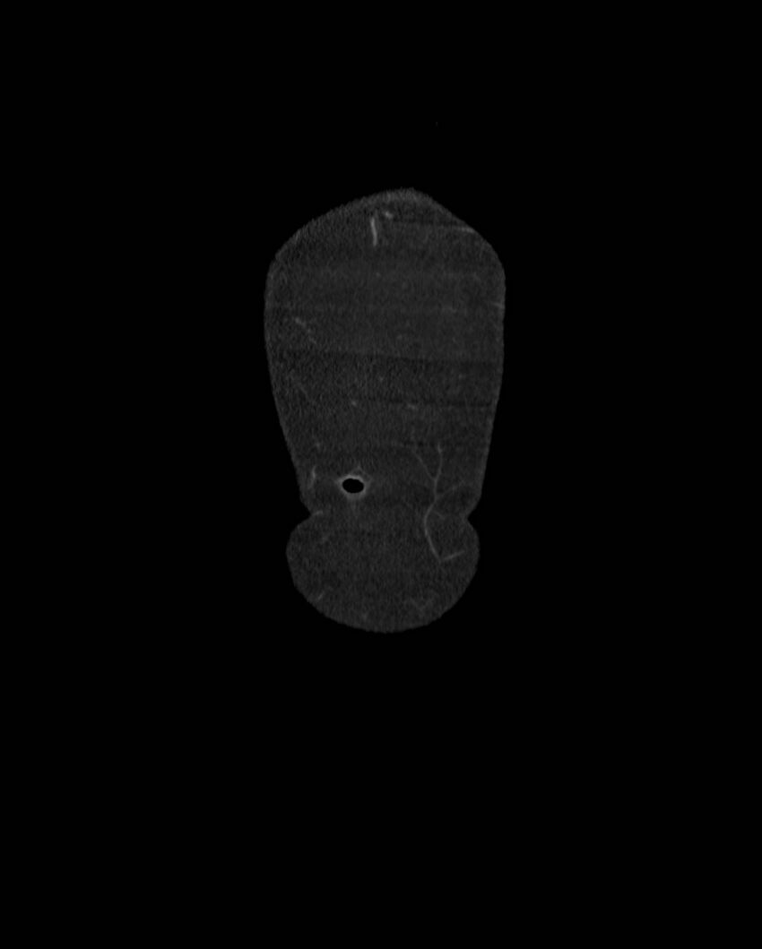 Cecal volvulus (Radiopaedia 54998-61310 B 4).jpg