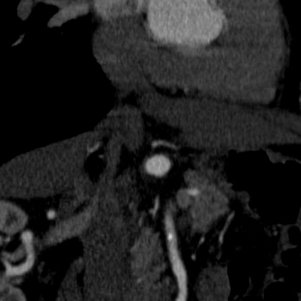 File:Celiac artery aneurysm (Radiopaedia 21574-21525 B 15).JPEG