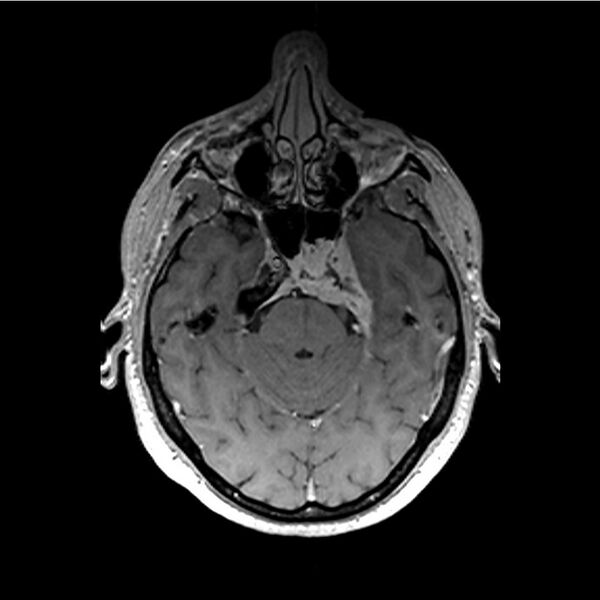 File:Central base of skull meningioma (Radiopaedia 53531-59549 Axial T1 C+ 12).jpg