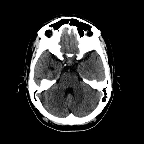 File:Central nervous system Langerhans cell histiocytosis (Radiopaedia 65728-74878 Axial non-contrast 18).jpg