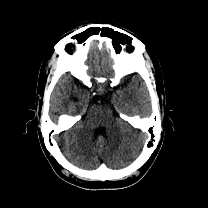 Central nervous system Langerhans cell histiocytosis (Radiopaedia 65728-74878 Axial non-contrast 18).jpg
