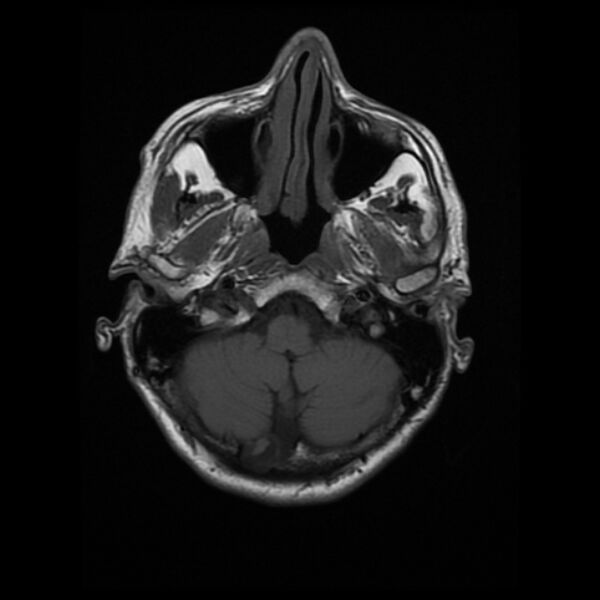 File:Central neurocytoma (Radiopaedia 67618-77021 Axial T1 5).jpg