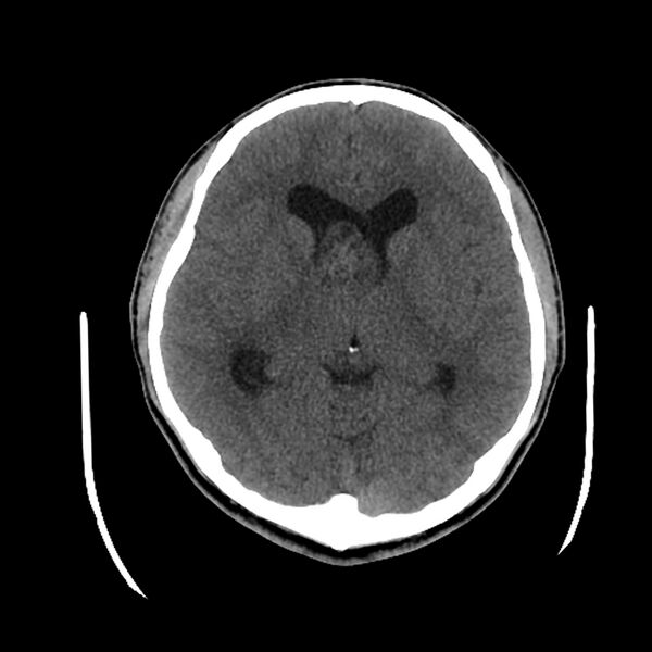 File:Central neurocytoma (Radiopaedia 79320-92379 Axial non-contrast 25).jpg