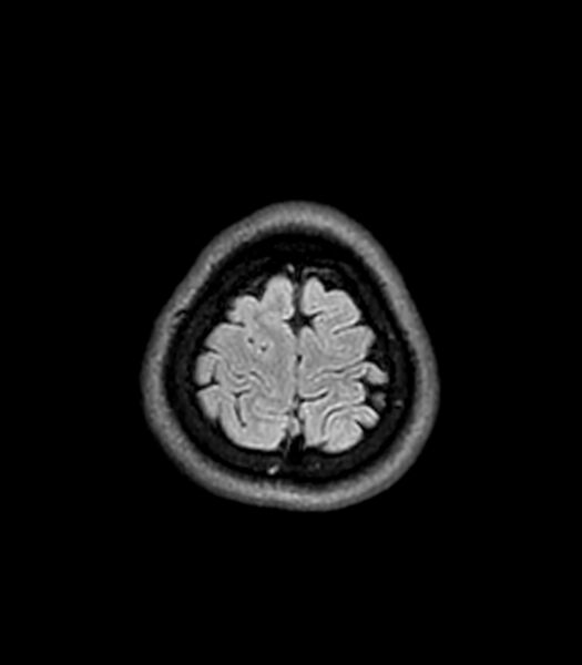 File:Central neurocytoma (Radiopaedia 79320-92380 Axial FLAIR 48).jpg