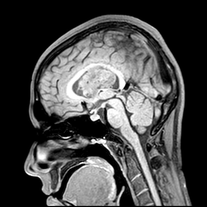 Central neurocytoma (Radiopaedia 79320-92380 Sagittal T1 132).jpg