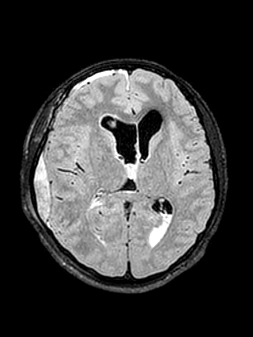 Central neurocytoma (Radiopaedia 79320-92381 Axial FLAIR 84).jpg