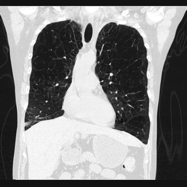 File:Centrilobular pulmonary emphysema (Radiopaedia 24495-24789 Coronal lung window 27).jpg