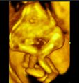 Cephalopagus conjoined twin (4D ultrasound) (Radiopaedia 84793-100256 D 1).jpg