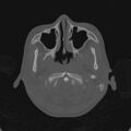Cerebellar abscess secondary to mastoiditis (Radiopaedia 26284-26413 Axial bone window 11).jpg