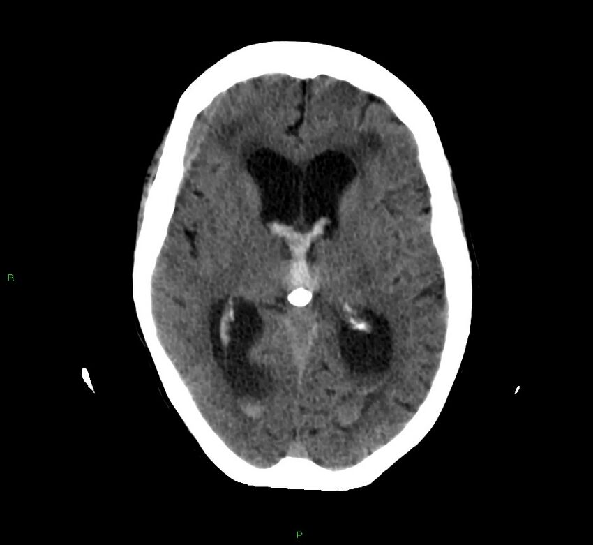 Cerebellar hemorrhage (Radiopaedia 58792-66026 Axial non-contrast 26).jpg