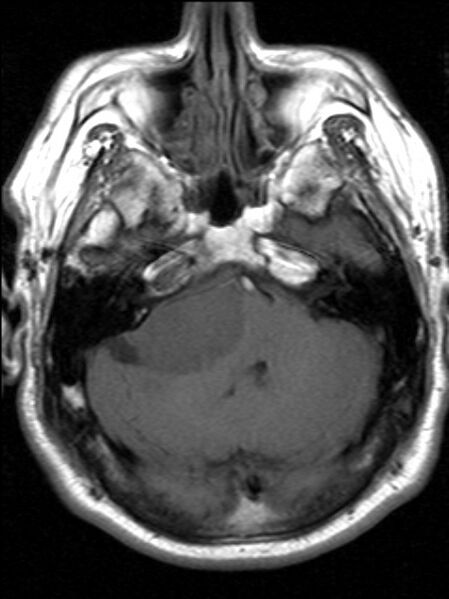 File:Cerebellopontine angle meningioma (Radiopaedia 24459-24764 Axial T1 5).jpg