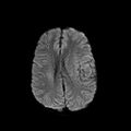 Cerebral abscess post cardiac surgery (Radiopaedia 27244-27420 Axial DWI 14).jpg