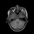 Cerebral abscess post cardiac surgery (Radiopaedia 27244-27420 Axial T1 6).jpg