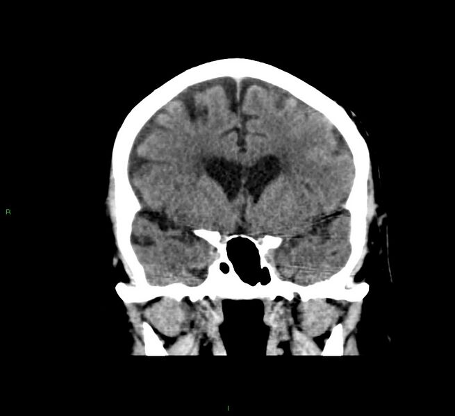 File:Cerebral amyloid angiopathy-associated lobar intracerebral hemorrhage (Radiopaedia 58376-65511 Coronal non-contrast 42).jpg