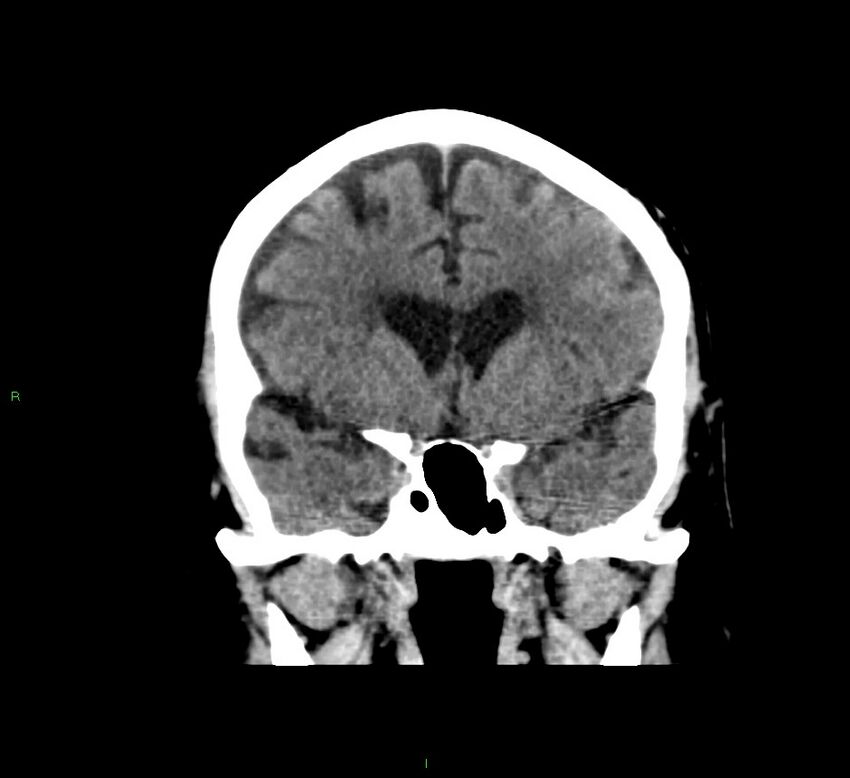 Cerebral amyloid angiopathy-associated lobar intracerebral hemorrhage (Radiopaedia 58376-65511 Coronal non-contrast 42).jpg