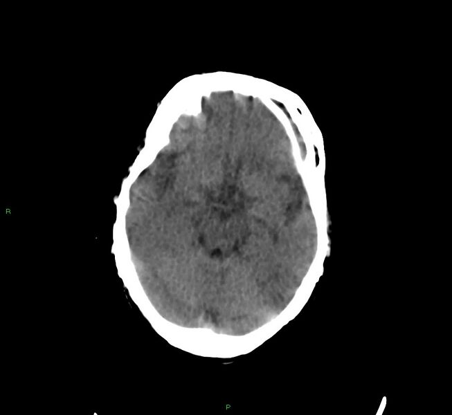 File:Cerebral amyloid angiopathy-associated lobar intracerebral hemorrhage (Radiopaedia 58377-65514 Axial non-contrast 31).jpg