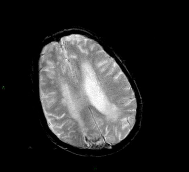 File:Cerebral amyloid angiopathy-associated lobar intracerebral hemorrhage (Radiopaedia 58377-65515 Axial Gradient Echo 10).jpg