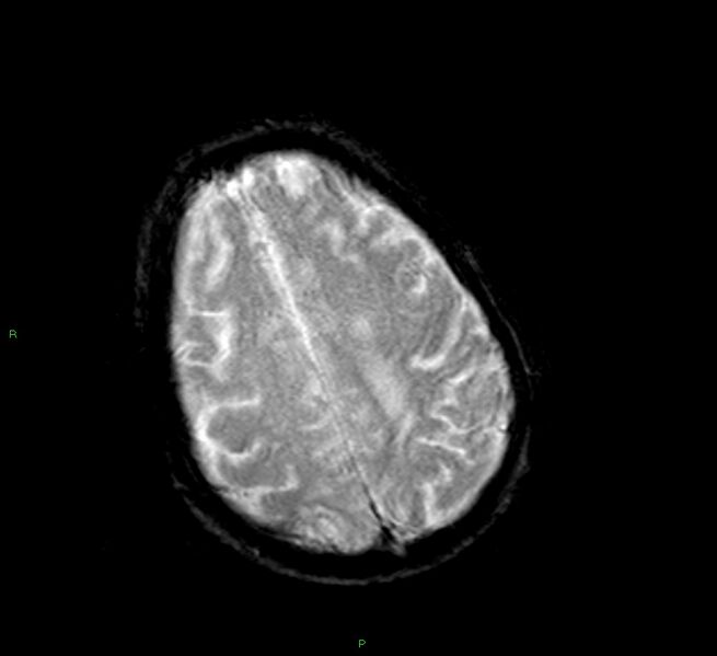 File:Cerebral amyloid angiopathy-associated lobar intracerebral hemorrhage (Radiopaedia 58377-65515 Axial Gradient Echo 8).jpg