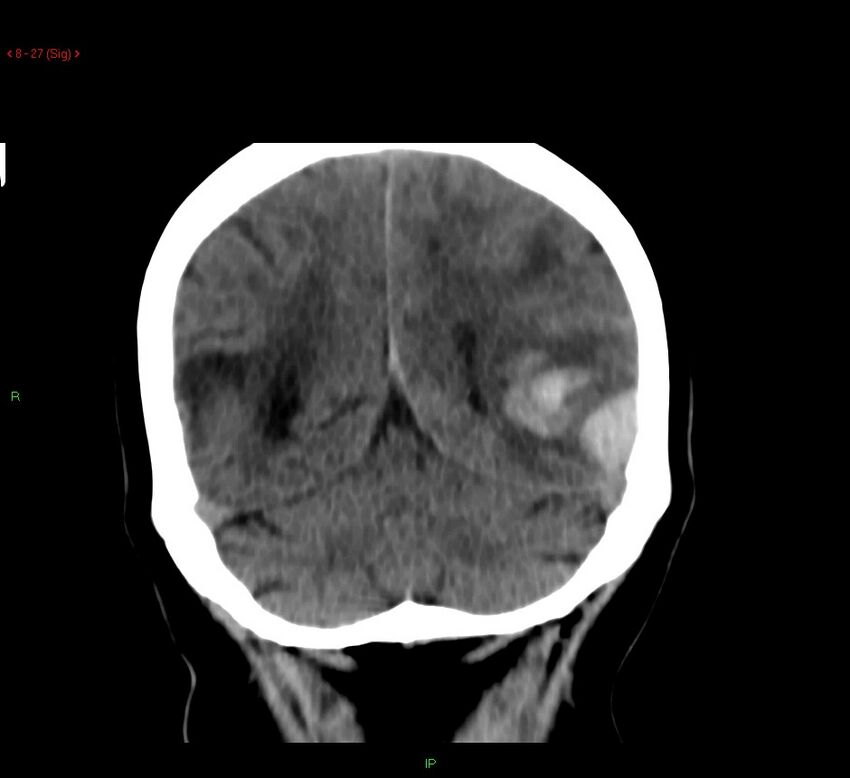 Cerebral amyloid angiopathy-associated lobar intracerebral hemorrhage (Radiopaedia 58378-65518 Coronal non-contrast 27).jpg