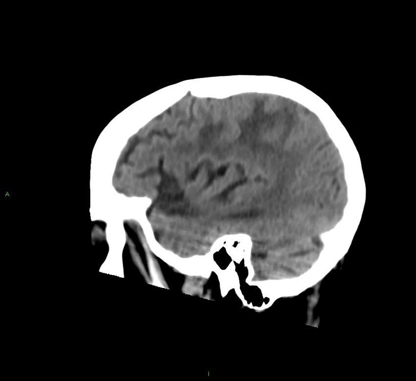 Cerebral amyloid angiopathy-associated lobar intracerebral hemorrhage (Radiopaedia 58530-65688 C 42).jpg