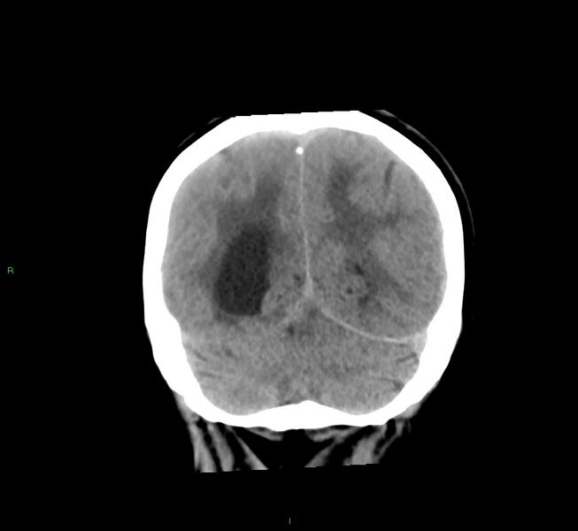 File:Cerebral amyloid angiopathy-associated lobar intracerebral hemorrhage (Radiopaedia 58561-65724 Coronal non-contrast 18).jpg