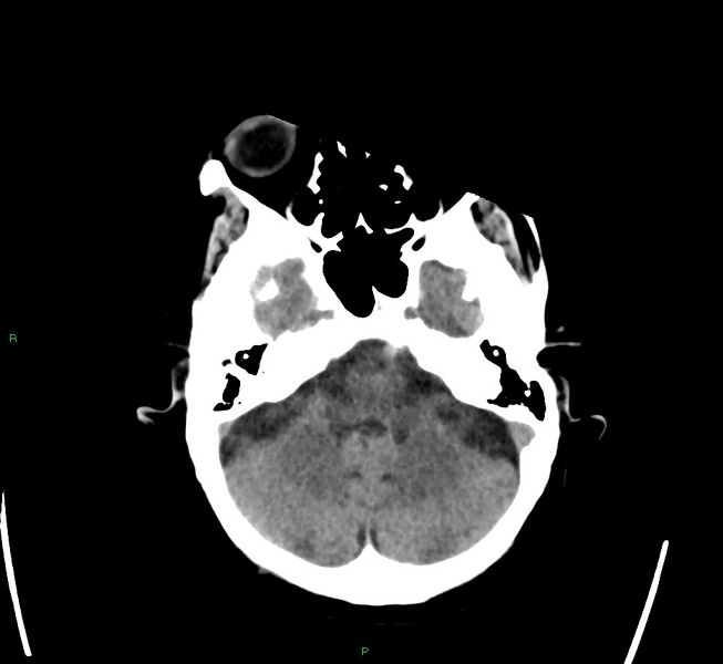 File:Cerebral amyloid angiopathy-associated lobar intracerebral hemorrhage (Radiopaedia 58563-65727 Axial non-contrast 42).jpg