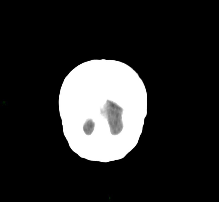 Cerebral amyloid angiopathy-associated lobar intracerebral hemorrhage (Radiopaedia 58751-65972 Coronal non-contrast 5).jpg
