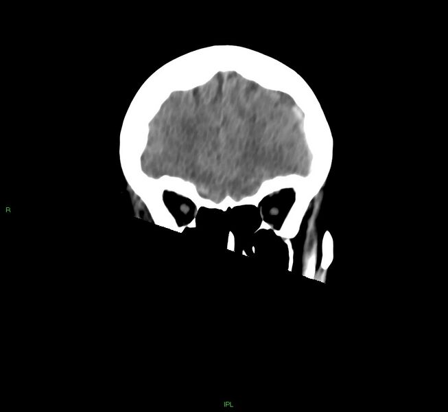 File:Cerebral amyloid angiopathy-associated lobar intracerebral hemorrhage (Radiopaedia 58754-65975 Coronal non-contrast 48).jpg