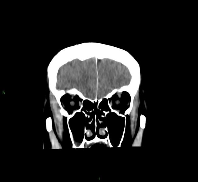 File:Cerebral amyloid angiopathy-associated lobar intracerebral hemorrhage (Radiopaedia 58756-65977 Coronal non-contrast 52).jpg