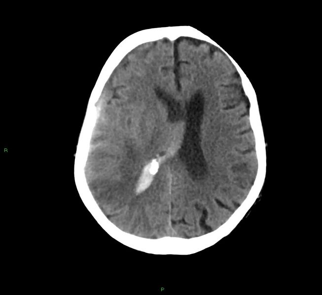 File:Cerebral amyloid angiopathy-associated lobar intracerebral hemorrhage (Radiopaedia 58758-65980 Axial non-contrast 20).jpg