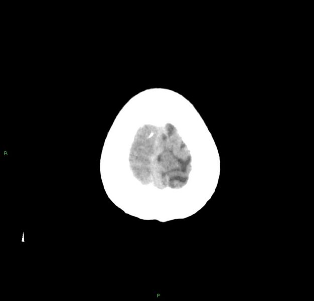 File:Cerebral amyloid angiopathy-associated lobar intracerebral hemorrhage (Radiopaedia 59356-66716 Axial non-contrast 4).jpg