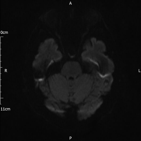 File:Cerebral amyloid angiopathy related inflammation (Radiopaedia 72772-83415 Axial DWI 54).jpg