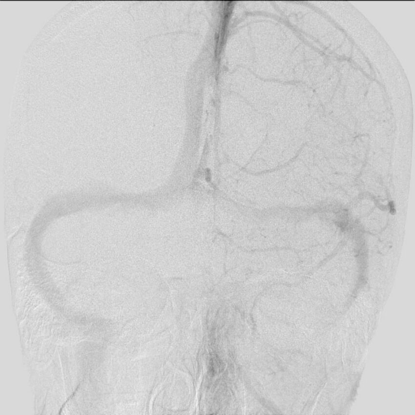 Cerebral aneurysm with rupture (Radiopaedia 29933-30458 LT ICA IC 23).jpg