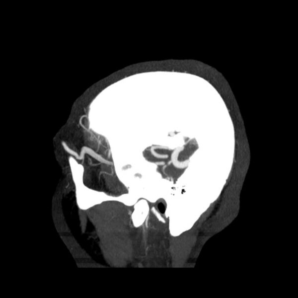 File:Cerebral arteriovenous malformation (Radiopaedia 43729-47189 D 47).jpg