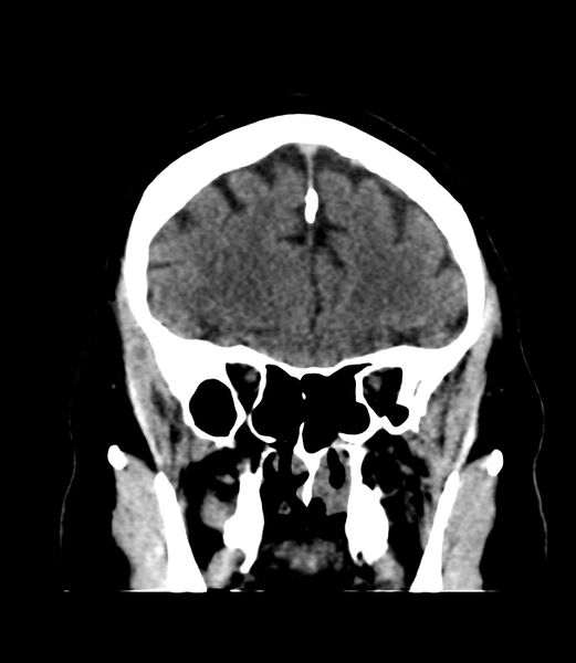 File:Cerebral dural venous sinus thrombosis (Radiopaedia 86514-102575 Coronal non-contrast 10).jpg